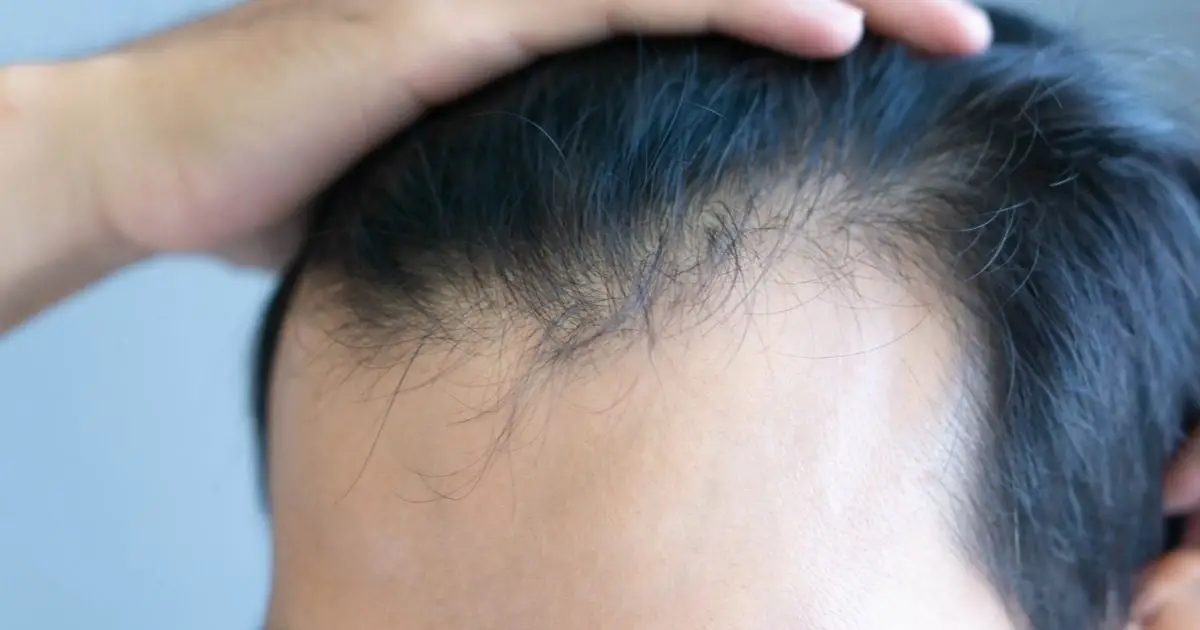 Uh Oh, GLP-1 Drugs Have Been Linked to a Higher Risk of Hair Loss