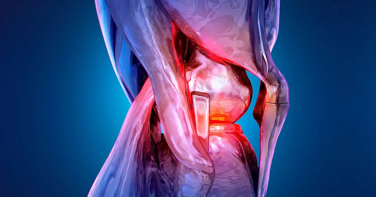 Non-Surgical Procedure Halves Knee Pain Over 12-Month Trial