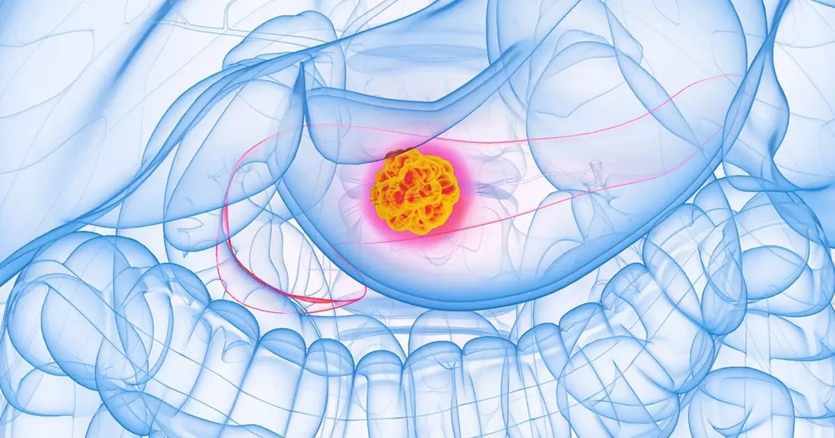 Experimental Drug Stops 90% of Pancreatic Cancer Cell Spread in Lab Tests