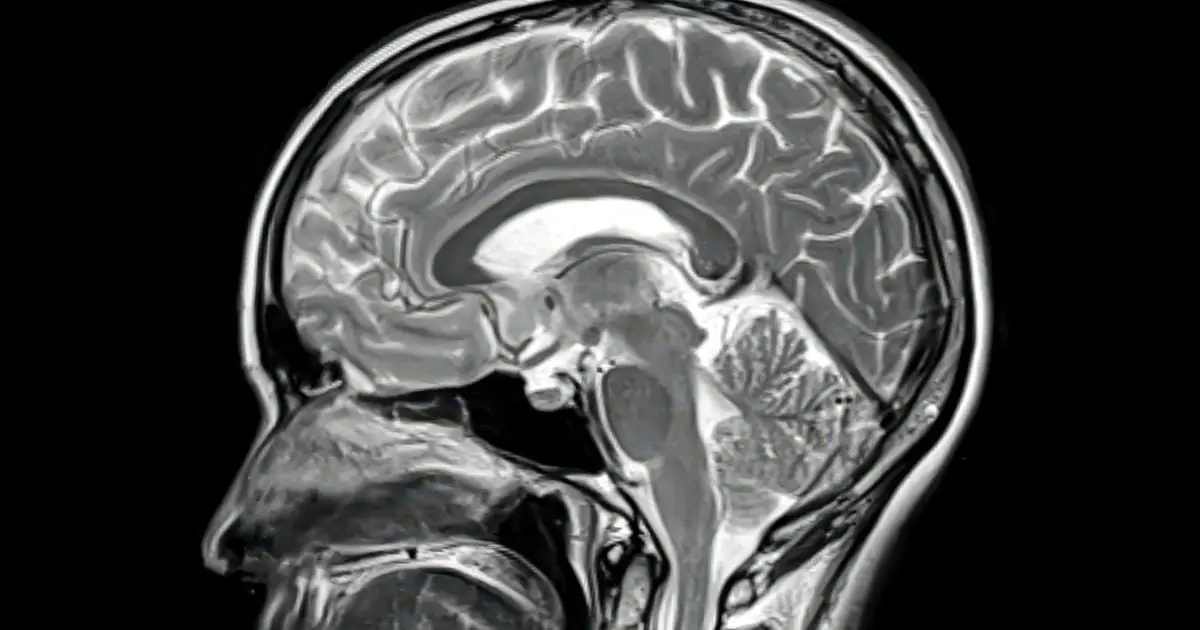 Rare Brain Autopsy Hints at Why Alzheimer's Drugs Are Failing
