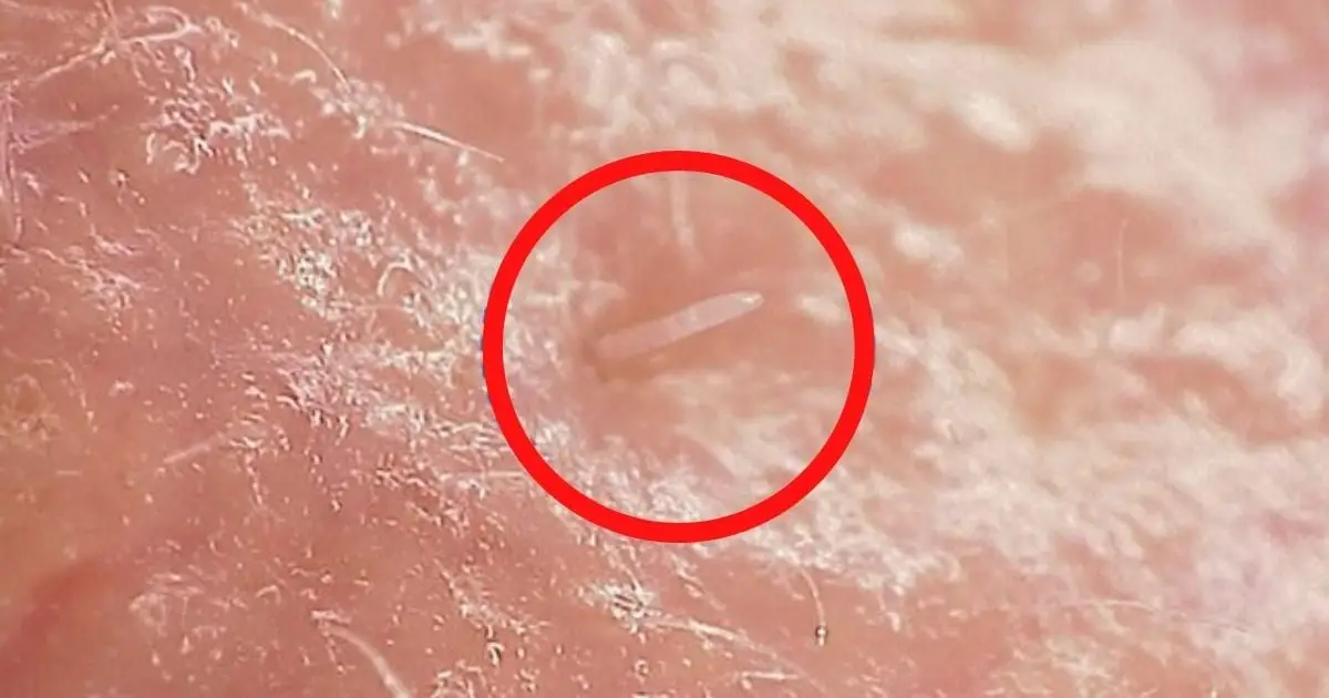 Mites Live on Your Face, And They're Starting to Merge With Humans