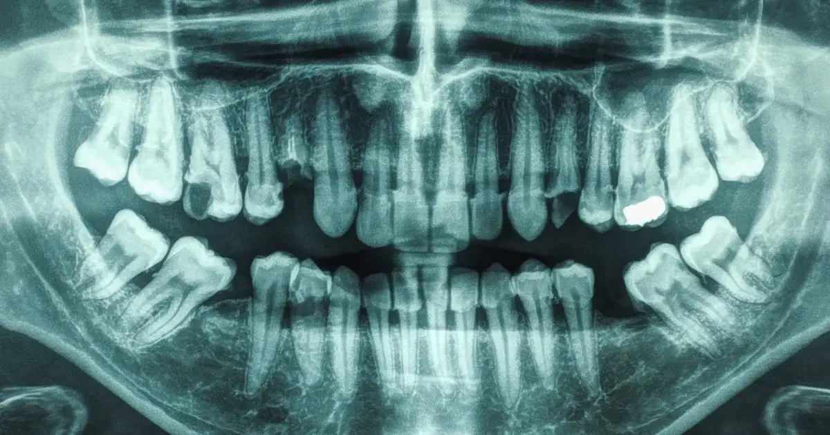 One Specific Diet Reduces Gum Disease in 6-Month Trial