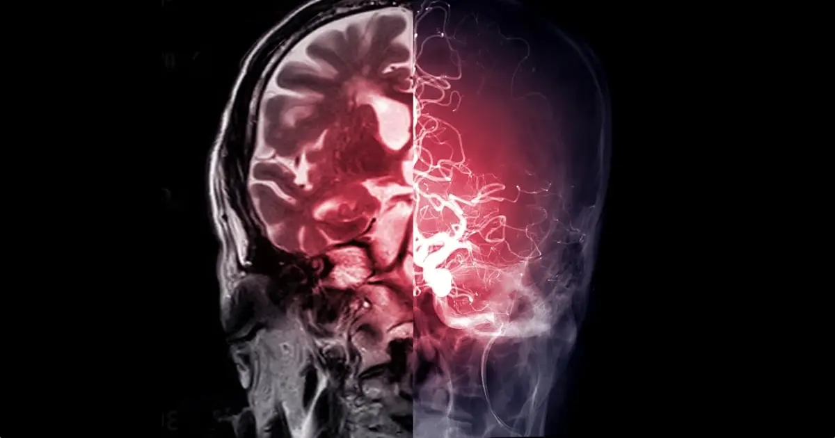 Diabetes Drug Used For More Than 60 Years Found to Unexpectedly Affect The Brain