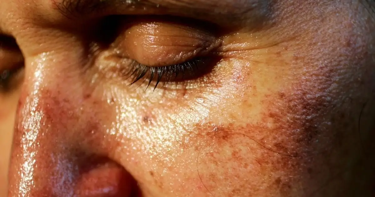 An Illegal Injectable Tanning Drug Is Trending on TikTok – And It's Giving People Dangerous Moles