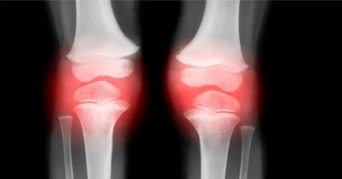 Single Injection Reverses Osteoarthritis in Animals in Just 4 Weeks