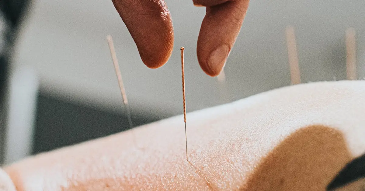 Acupuncture Seems to Rewire The Brain in Depression, Scans Reveal