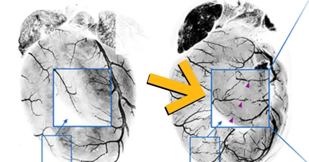 Your Heart Can Actually Build Its Own Bypass After a Heart Attack