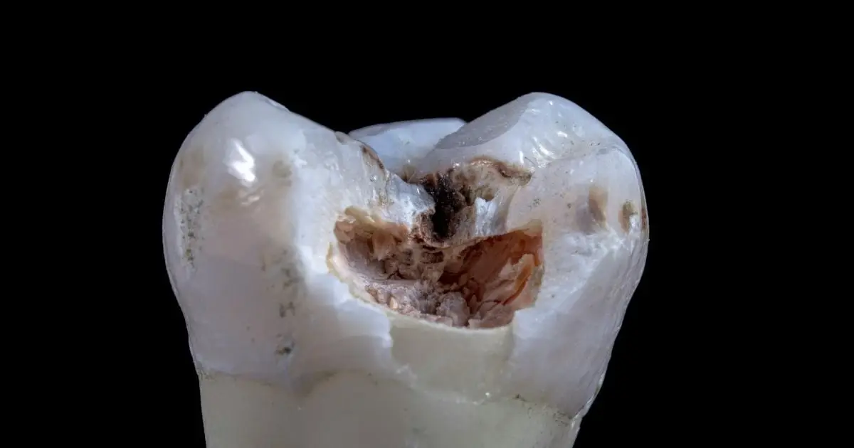 A 10-Second Treatment Can Stop Tooth Decay in Kids Without Drilling