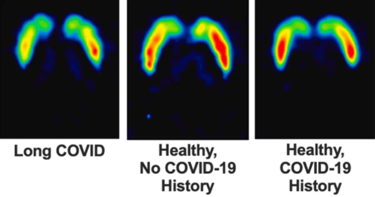 Long COVID Linked to Lasting Damage in The Brain's Dopamine System