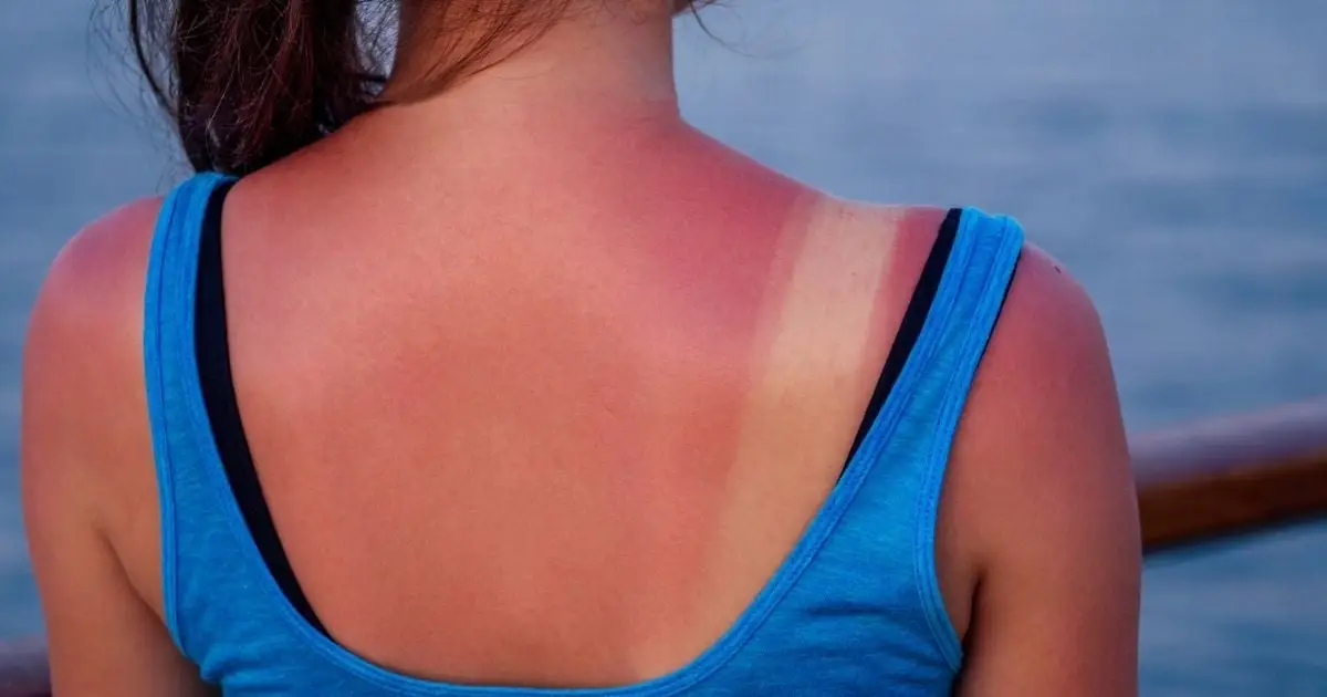 Bad News: Just One Intense Sunburn Really Can Be 'Life-Changing'
