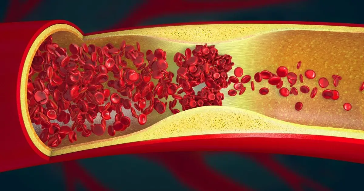 Scientists Find 'Ominous' Signs of Artery Damage in Nearly 8 in 10 Young Adults