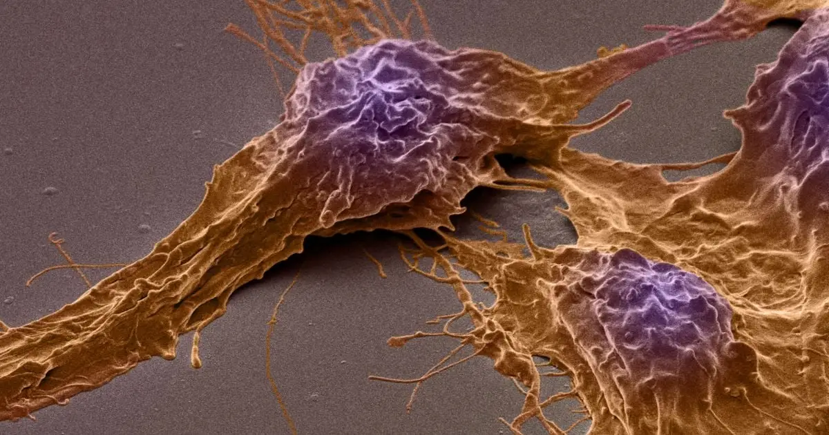 This Deadly Brain Cancer Hijacks Brain Activity to Fuel Its Growth, Study Reveals