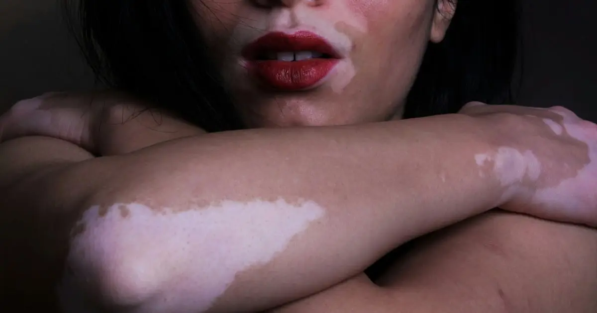 This Once-Daily Pill Helps The Skin Regain Its Color in People With Vitiligo