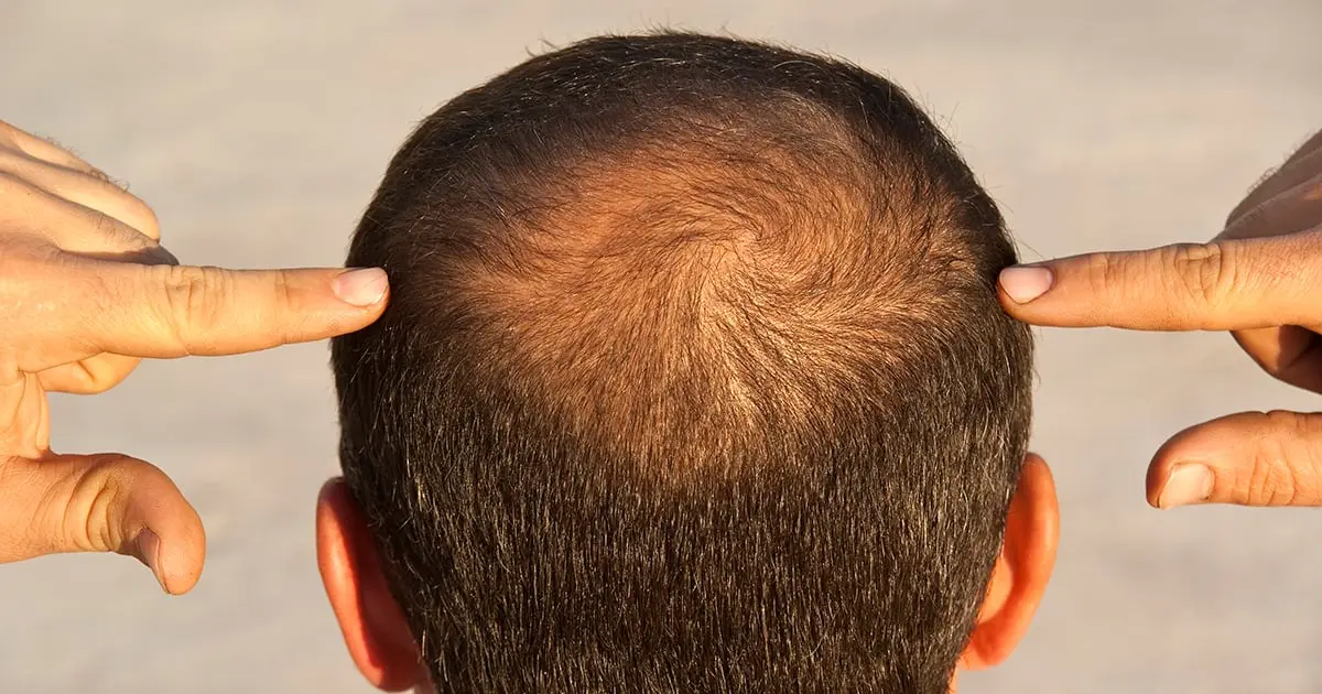 GLP-1 Drugs Could Nudge Some Men Toward Hair Loss, Study Suggests