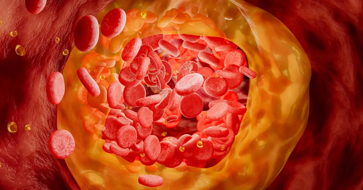 Experimental One-Dose Treatment Cuts 'Bad' Cholesterol by 52% in First Human Trial