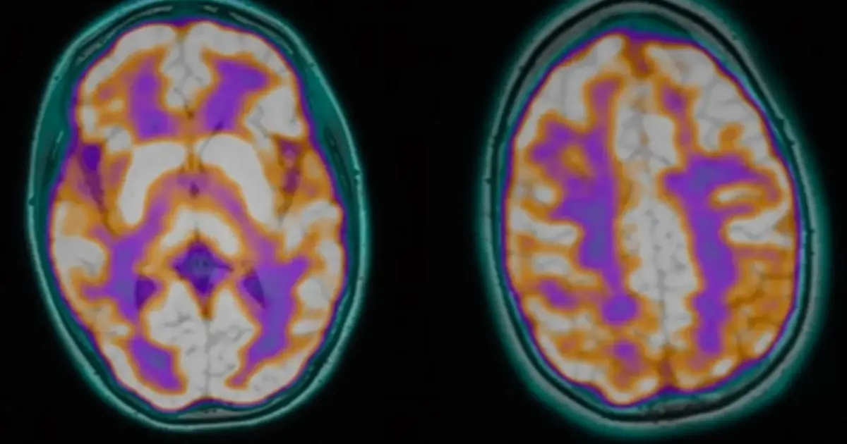 After These Young People Died, Postmortems Found an Unnerving Parasite Link