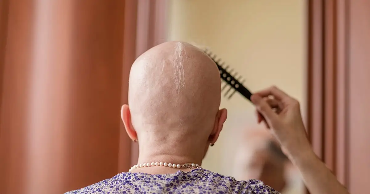 Arthritis Drug Restores Up to 100% of Hair in Patients With Severe Alopecia