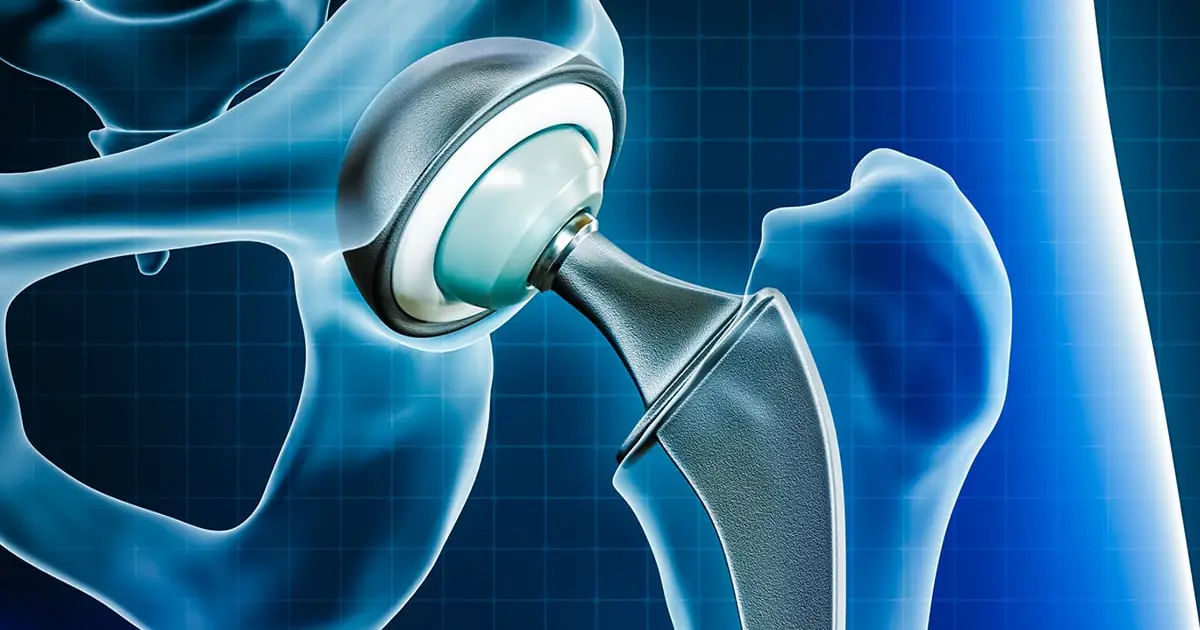 Metal Particles From Joint Replacements Can Reach Your Brain, Study Finds