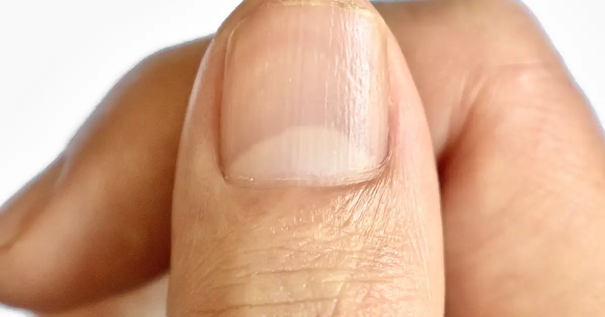 This Subtle Change to Your Fingernails Can Be a Sign of Hidden Disease