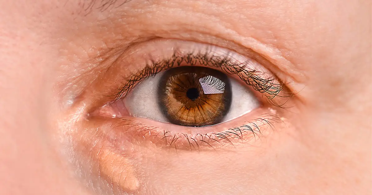 A Warning Sign of Heart Attack And Stroke May Show Up on Your Face