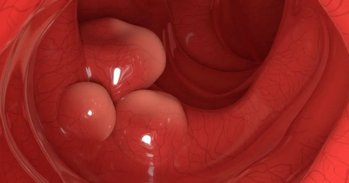 Engineered Probiotic Wipes Out 43% of Colorectal Tumors in Mice