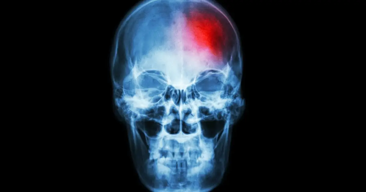 A Hidden Source of Chronic Pain May Be Lurking Inside Your Skull, Study Finds