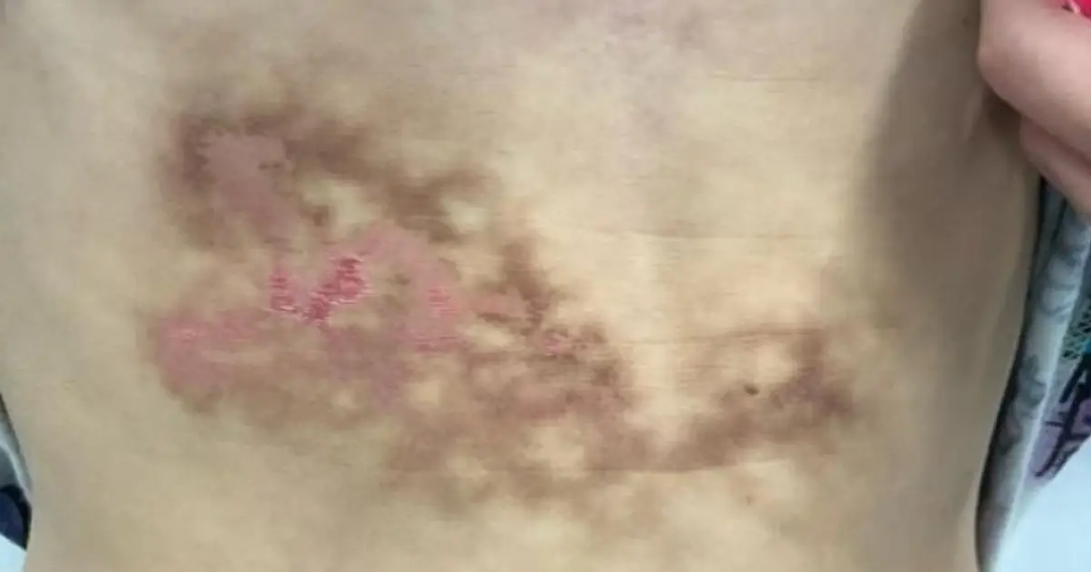 Bizarre Rash Was Thought to Be a Liver Injury, But It Was Caused by a Common Habit