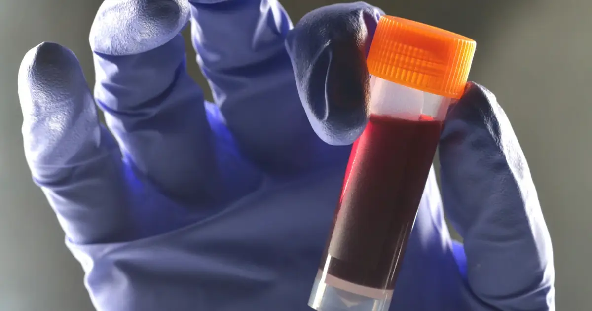 One Blood Type Seems to Carry a Higher Risk of Type 2 Diabetes