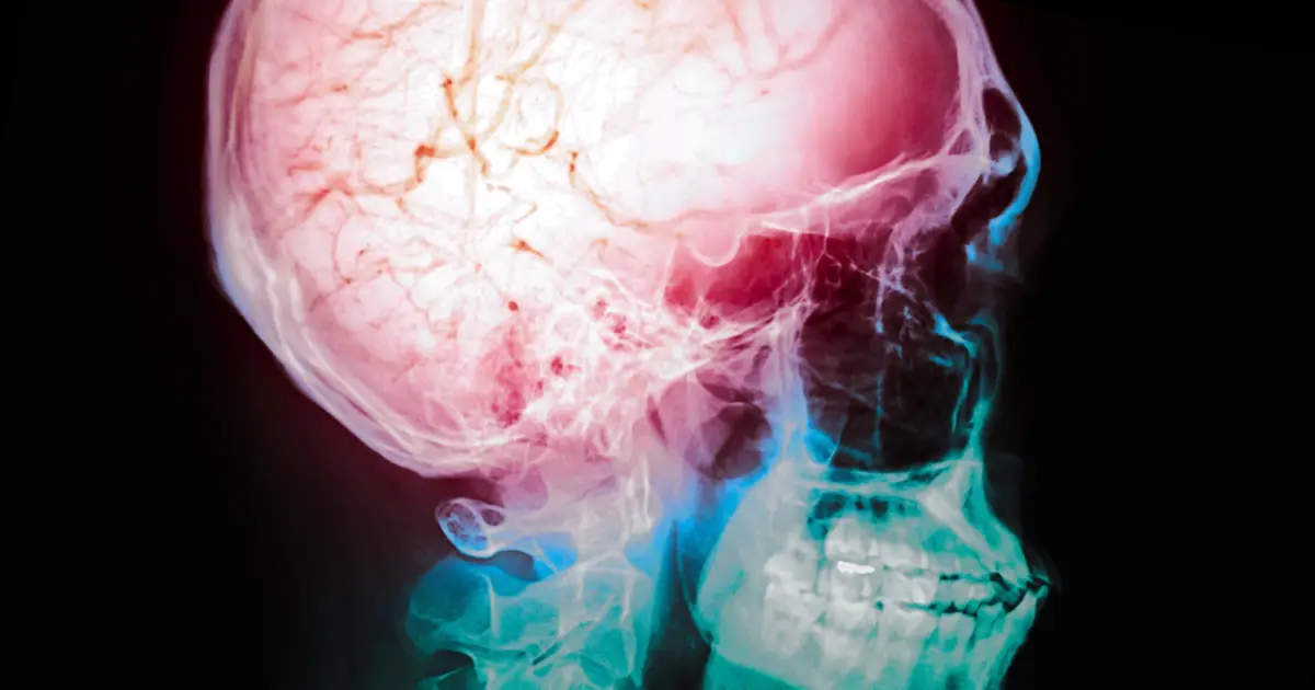 The Treatment Window For Some Strokes May Be Far Longer Than We Thought, But There's a Catch