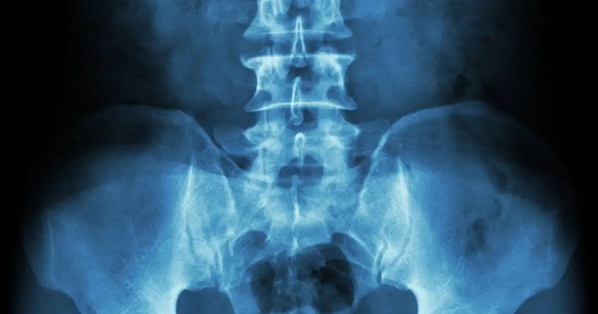Testosterone May Have an Unexpected Benefit For Women's Bones After Menopause