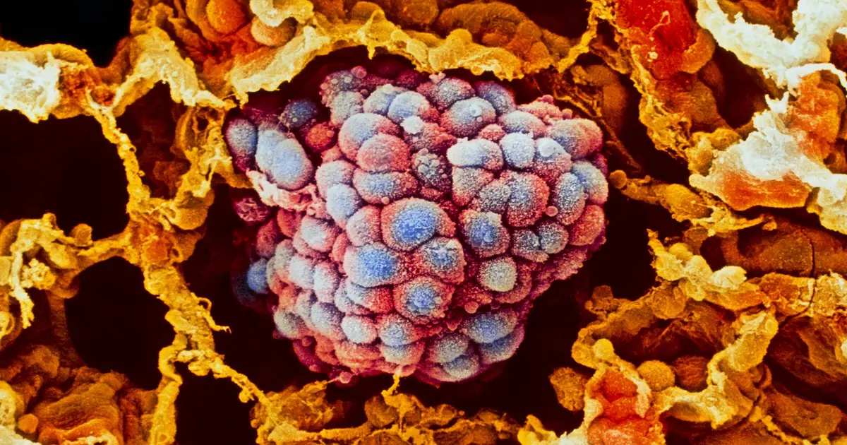 A Cheap Deworming Pill Could Help Beat Drug-Resistant Lung Cancer