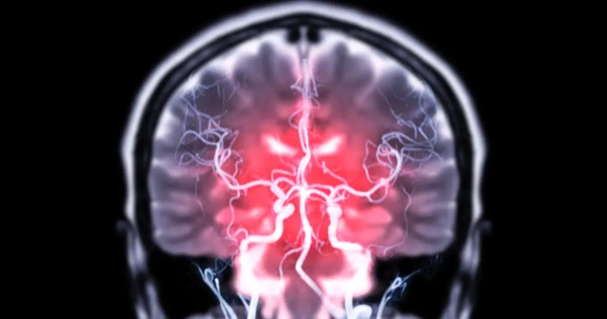 Obesity Linked to Twice The Volume of Brain Abnormalities, Study Finds