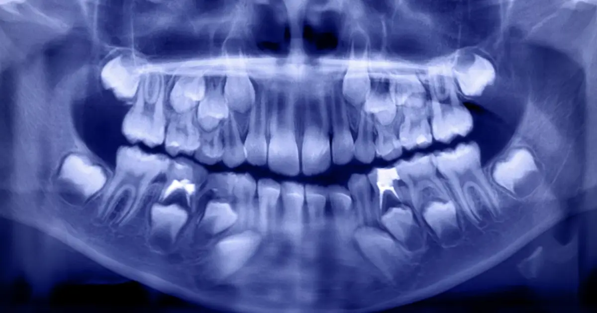 Higher Levels of 19 Potentially Toxic Chemicals Found in The Teeth of Children With Autism