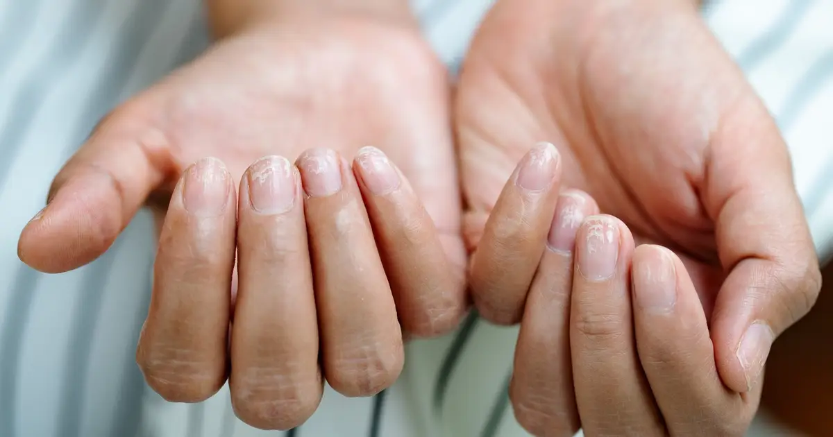 Some People Taking Ozempic-Like Drugs Are Reporting Their Fingernails Detaching