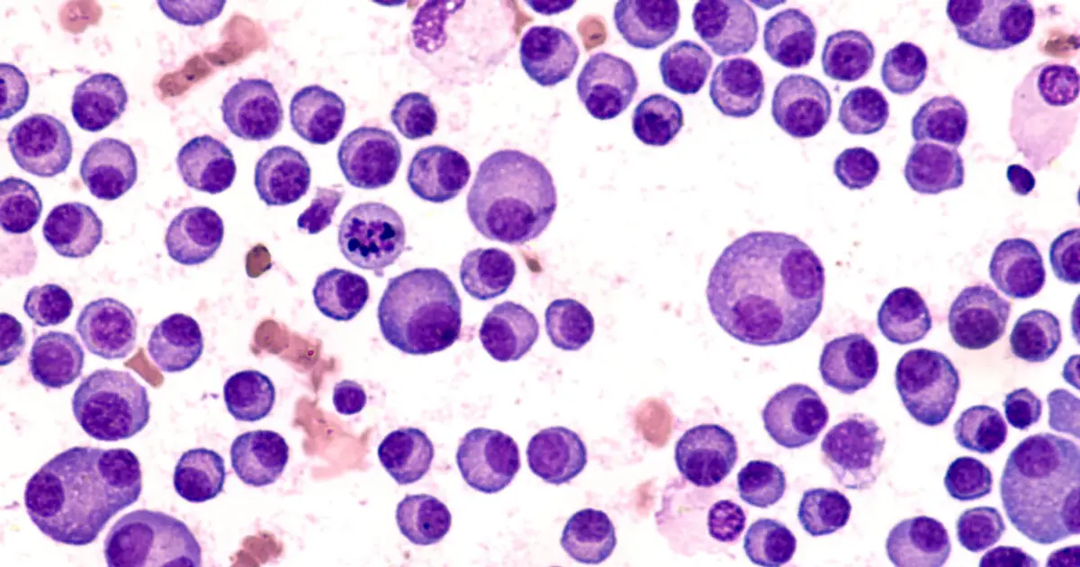 STAT+: In early trial, CAR-T results raise hope of preventing multiple myeloma in high-risk patients