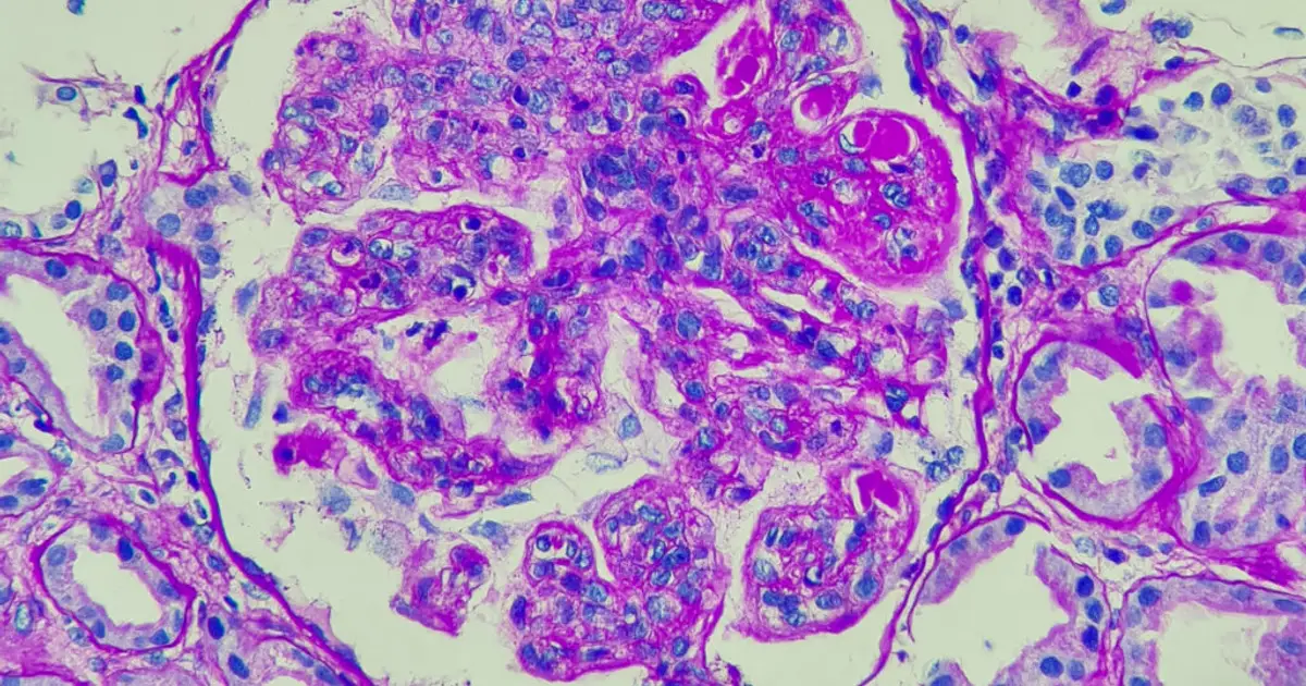 STAT+: 5 years after lupus breakthrough, CAR-T is still surprising autoimmunity researchers