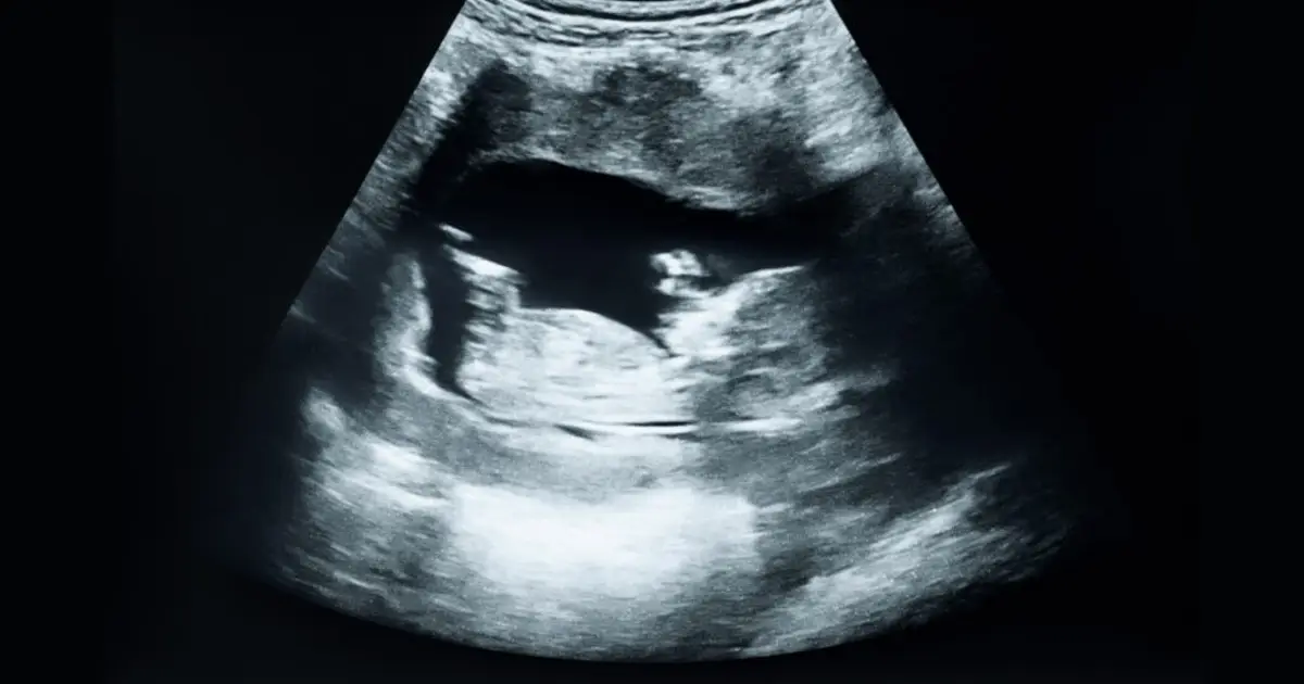 C-section rate in 2025 highest in a decade