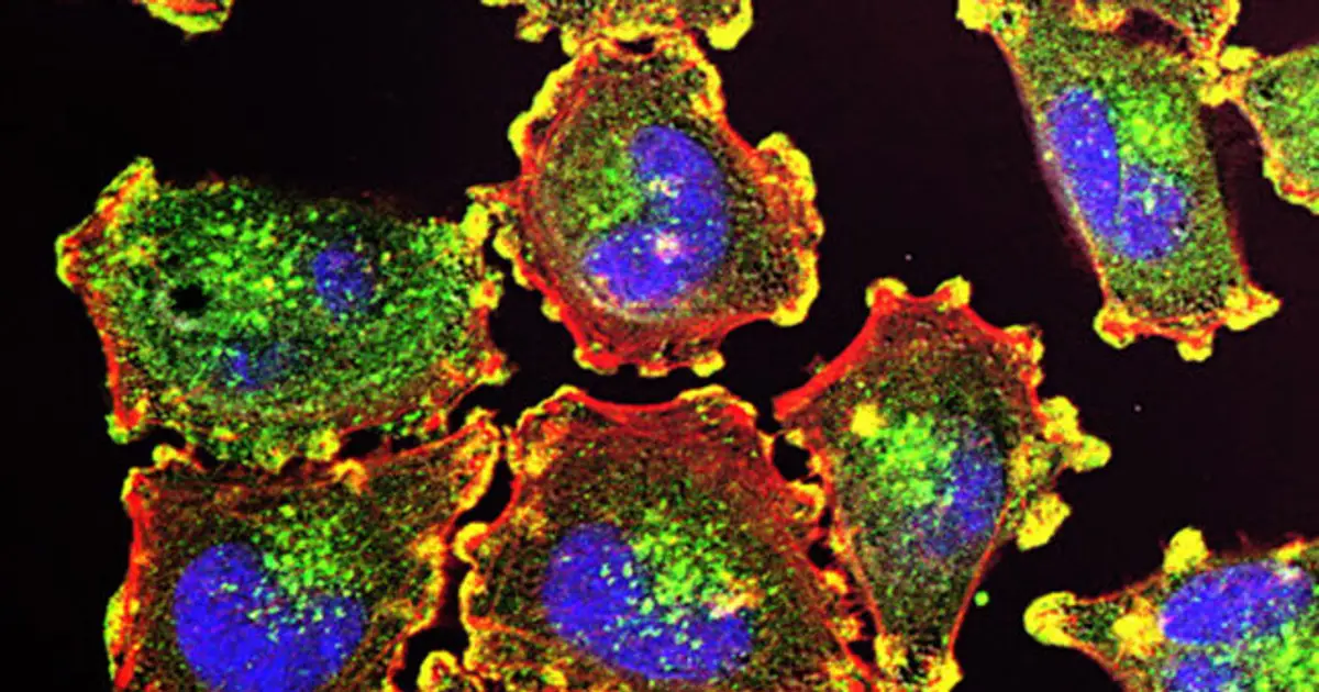 After a melanoma diagnosis, mRNA cancer vaccine delivered a patient hope — and a path forward