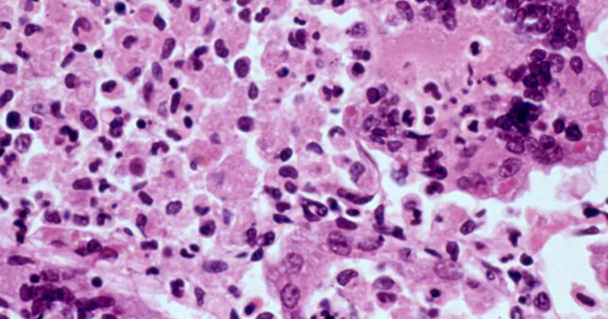 One of the most contagious diseases on the planet is having its worst U.S. outbreak since 1991