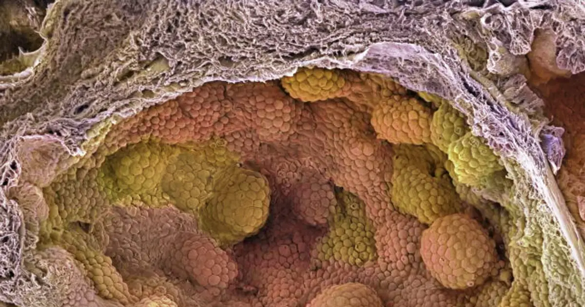 STAT+: For prostate cancer patients set on surgery, new hormone regimen may improve outcomes, study finds