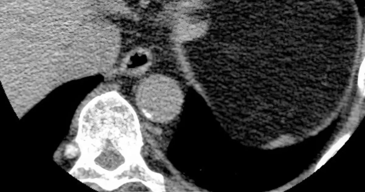 On the fence about a statin? In borderline cases, calcium scans could be a tiebreaker