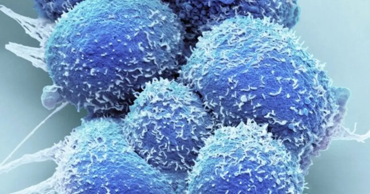Focal therapy for localized prostate cancer has divided physicians. Will new data change minds?