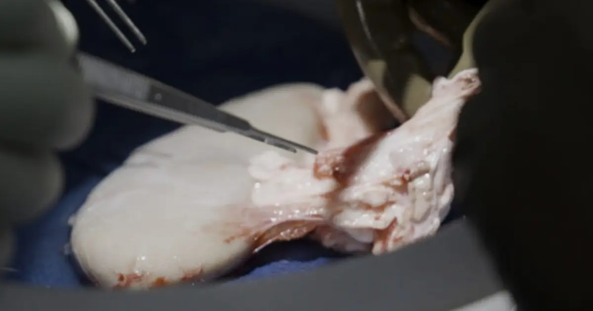 STAT+: Recipients of gene-edited pig kidneys successfully receive human organs