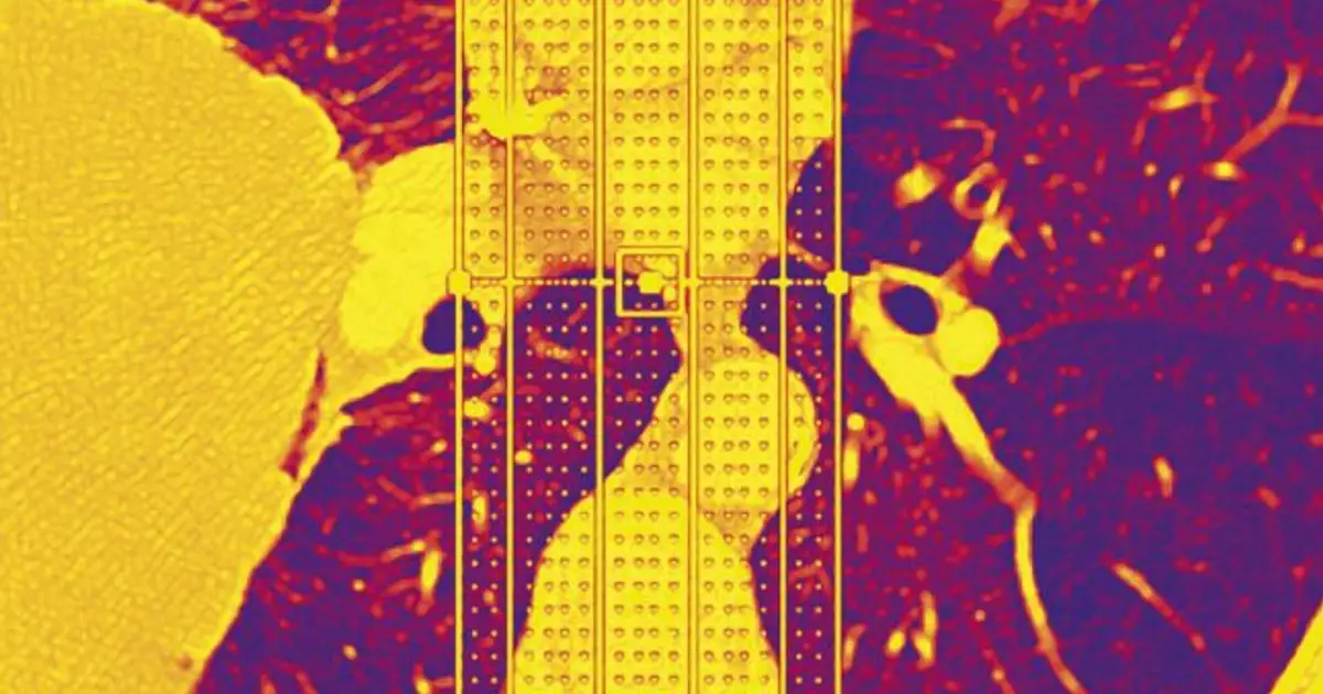 STAT+: Why do ‘never smokers’ get lung cancer? In some cases, rare genetic variant may be a factor
