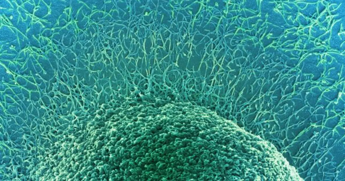 STAT+: New atlas of colorectal tumors sheds light on why cancers in young people are more dangerous